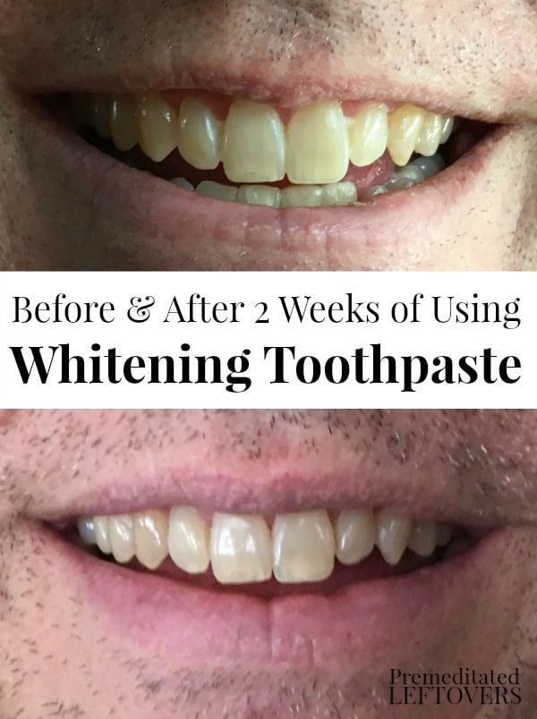 Before and after pictures results after 2 weeks of using whitening toothpaste